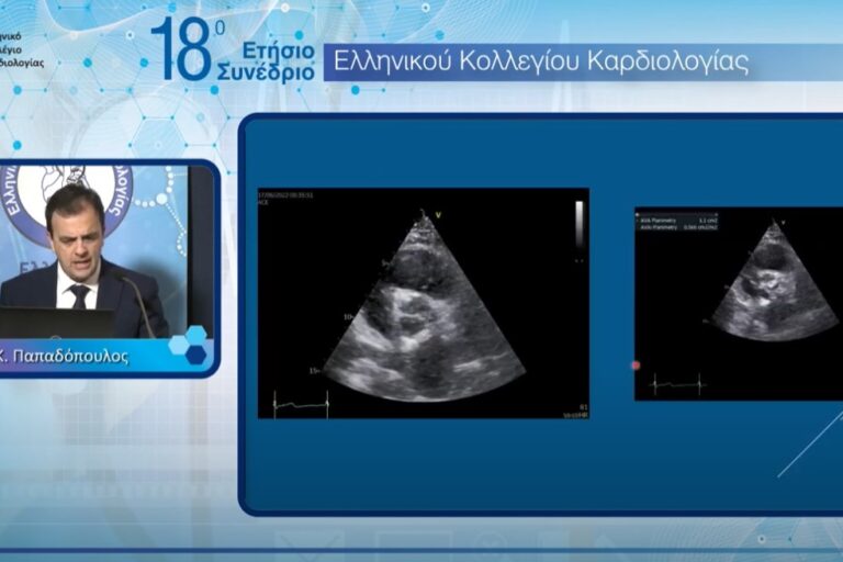 Στένωση της αορτής με φυσιολογικό κλάσμα εξώθησης και χαμηλή κλίση πίεσης