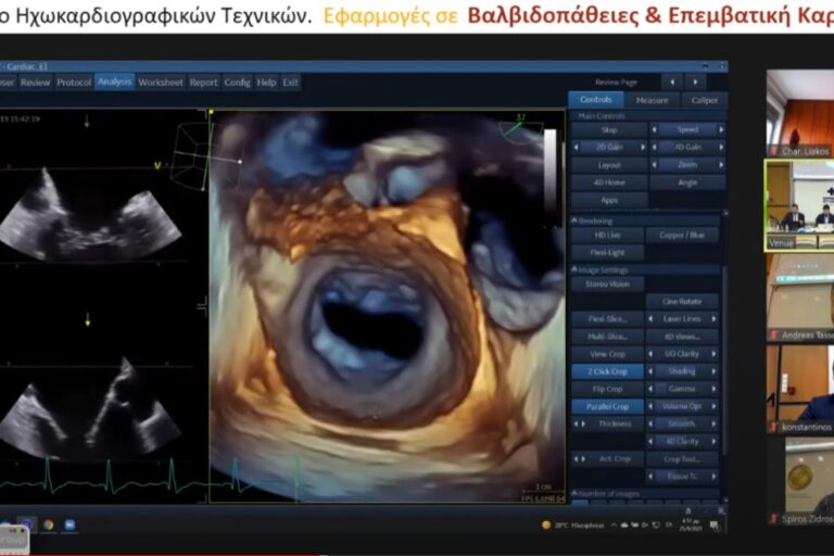 Τριδιάστατη απεικόνιση και εκτίμηση μιτροειδούς βαλβίδας