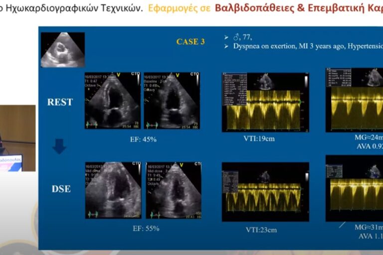 Χαμηλής ροής – χαμηλής κλίσης πίεσης αορτική στένωση